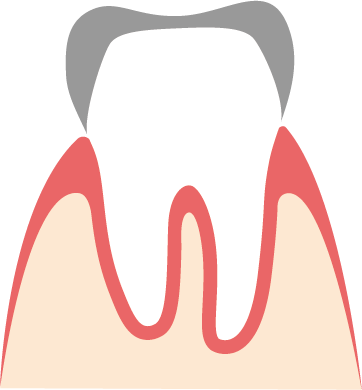 Unverblendete Metall-Kronen sind silbern Bild einer Metall-Krone