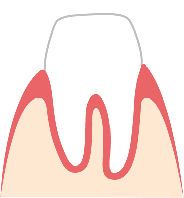 Keramik-Kronen bestehen meisten aus Zirkon Bild einer Zirkon-Krone
