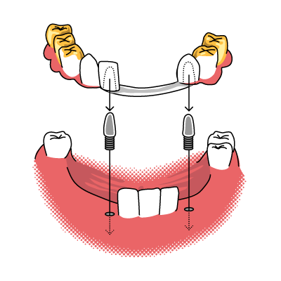 Teleskopierendn Brücke in Gold  Bild einer teleskopierenden Brücke in Gold gearbeitet